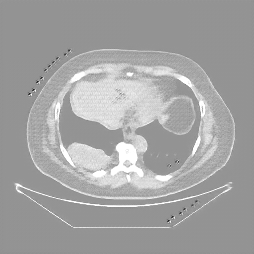 Reconstructed NATIVE CT scan (cycle consistency)