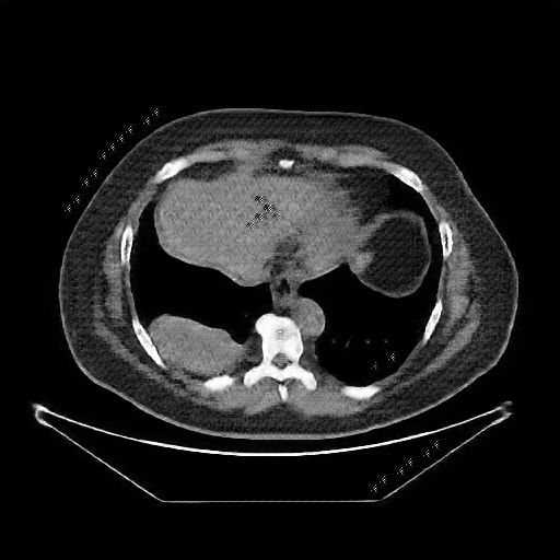 Reconstructed NATIVE CT scan (cycle consistency)