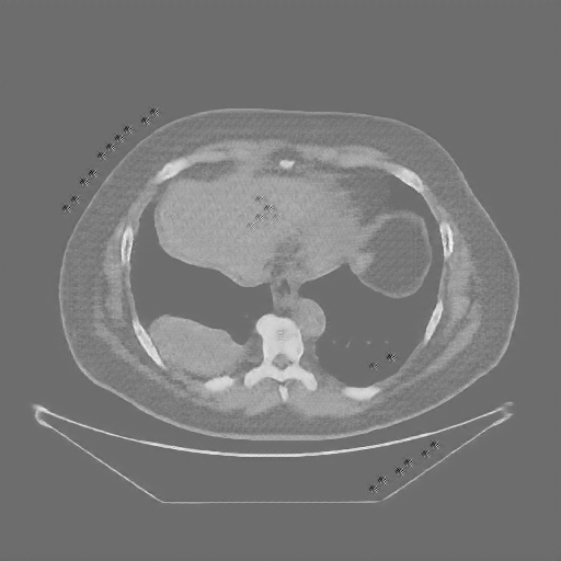Reconstructed NATIVE CT scan (cycle consistency)