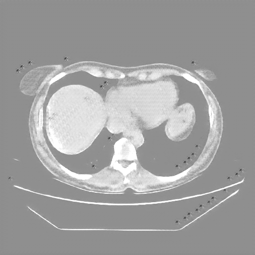 Reconstructed NATIVE CT scan (cycle consistency)