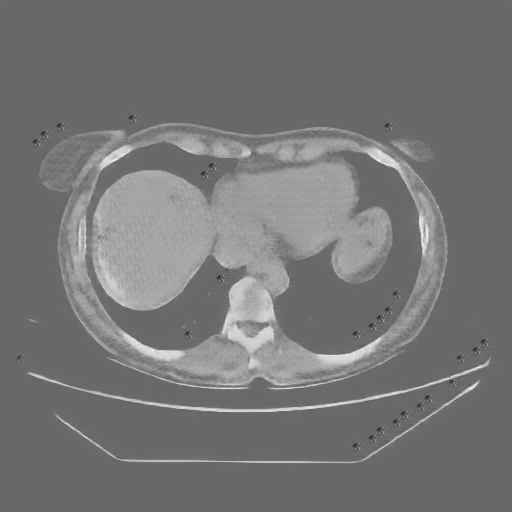 Reconstructed NATIVE CT scan (cycle consistency)