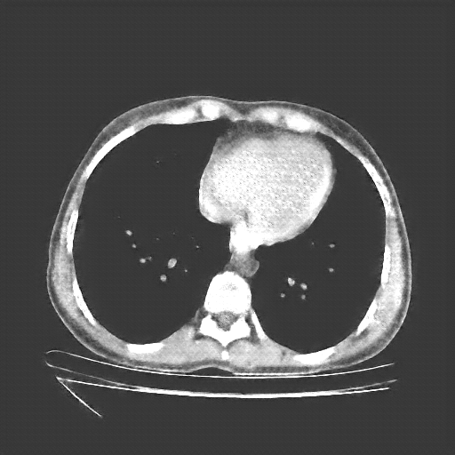 Generated VENOUS CT scan (A→B translation)