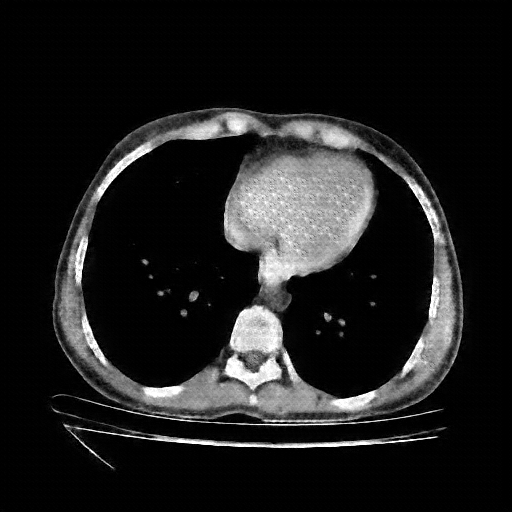 Generated VENOUS CT scan (A→B translation)