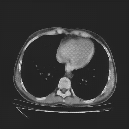 Generated VENOUS CT scan (A→B translation)
