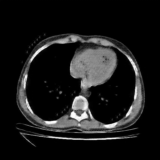 Reconstructed NATIVE CT scan (cycle consistency)