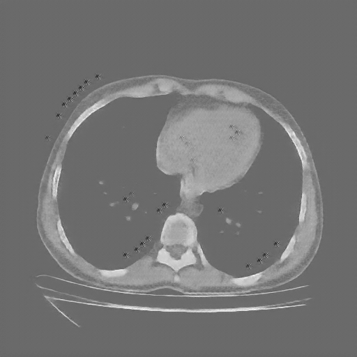 Reconstructed NATIVE CT scan (cycle consistency)