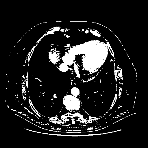 Original VENOUS CT scan