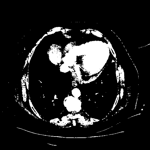 Reconstructed NATIVE CT scan (cycle consistency)