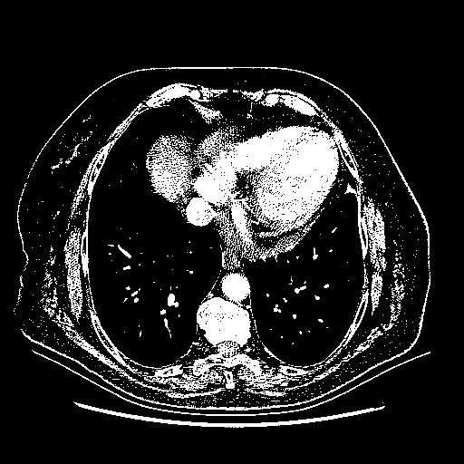 Original NATIVE CT scan (input)
