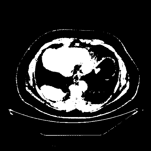 Reconstructed NATIVE CT scan (cycle consistency)