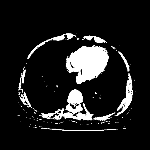 Original VENOUS CT scan
