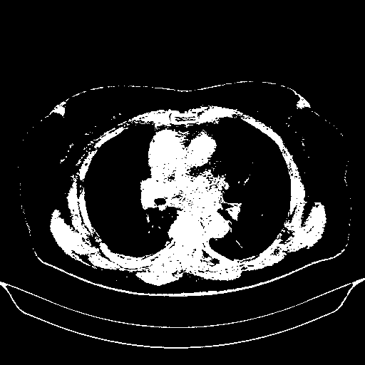 Reconstructed NATIVE CT scan (cycle consistency)