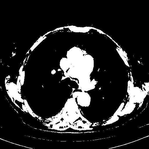 Reconstructed NATIVE CT scan (cycle consistency)