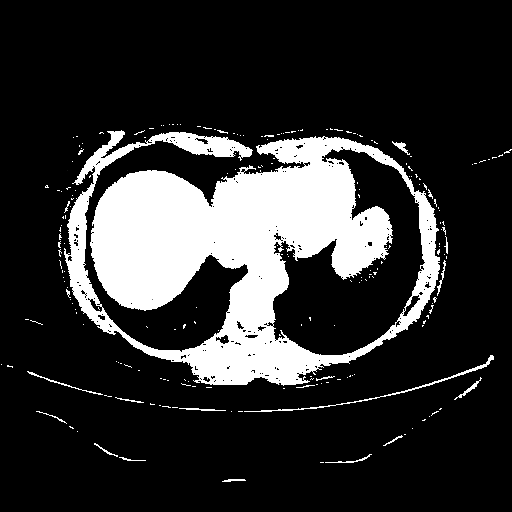 Reconstructed NATIVE CT scan (cycle consistency)