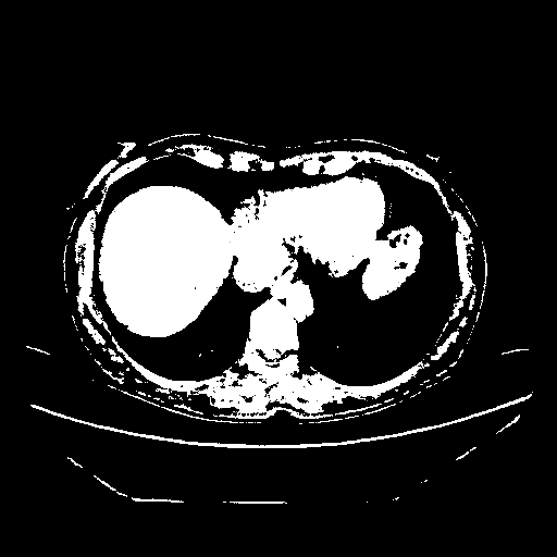 Original VENOUS CT scan