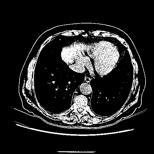 Original NATIVE CT scan (input)