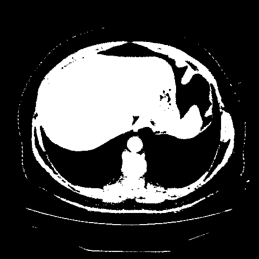 Reconstructed NATIVE CT scan (cycle consistency)