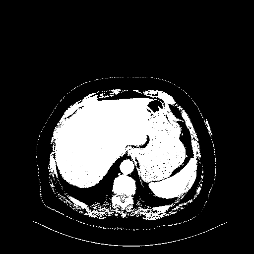 Generated VENOUS CT scan (A→B translation)