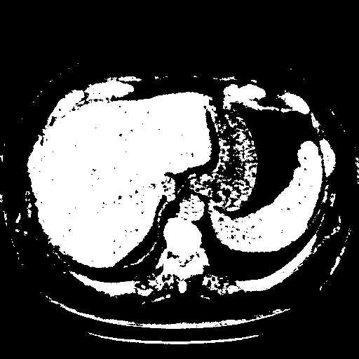 Original VENOUS CT scan