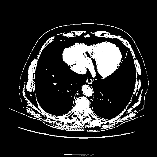 Original VENOUS CT scan