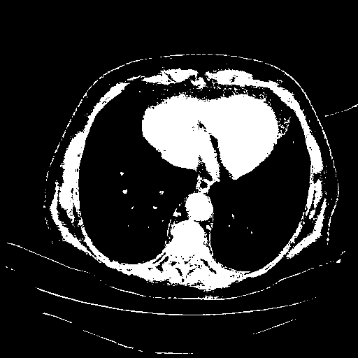 Reconstructed NATIVE CT scan (cycle consistency)