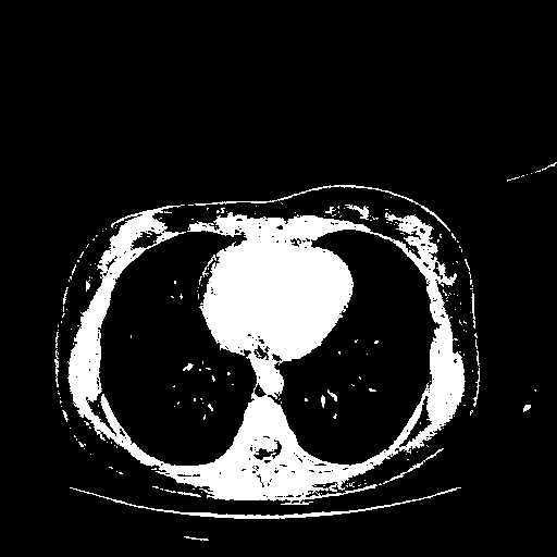Reconstructed NATIVE CT scan (cycle consistency)