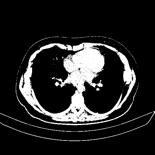 Original NATIVE CT scan (input)