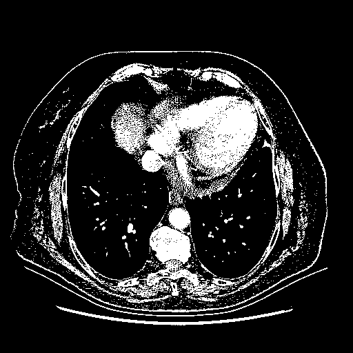 Original NATIVE CT scan (input)