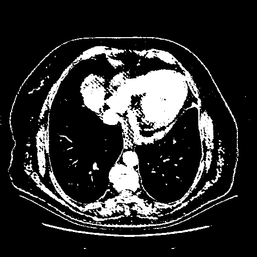 Original VENOUS CT scan