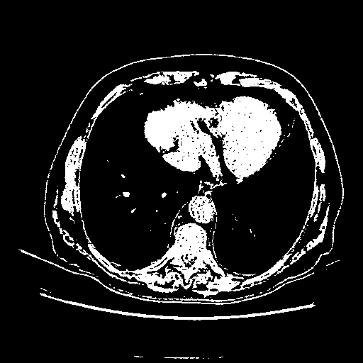 Original VENOUS CT scan