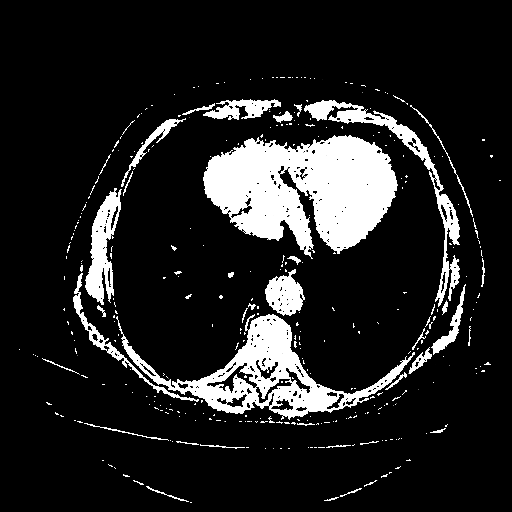 Reconstructed NATIVE CT scan (cycle consistency)