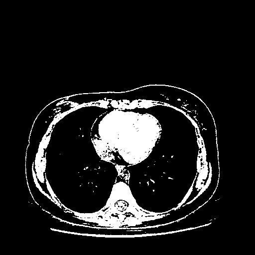 Original VENOUS CT scan