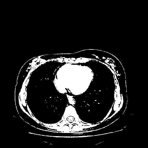 Reconstructed NATIVE CT scan (cycle consistency)