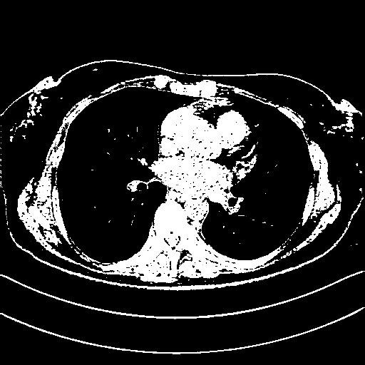 Original VENOUS CT scan