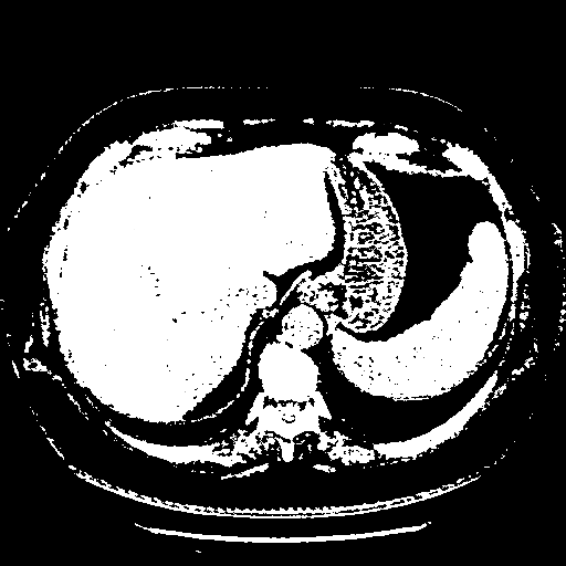 Original VENOUS CT scan