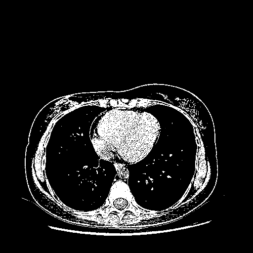 Original NATIVE CT scan (input)