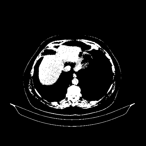 Original NATIVE CT scan (input)