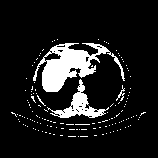 Reconstructed NATIVE CT scan (cycle consistency)