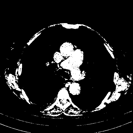 Original VENOUS CT scan