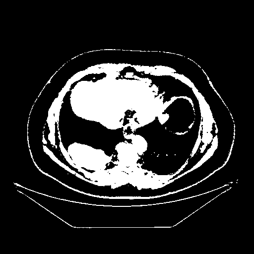 Reconstructed NATIVE CT scan (cycle consistency)