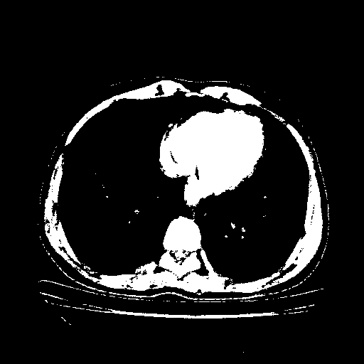 Original VENOUS CT scan