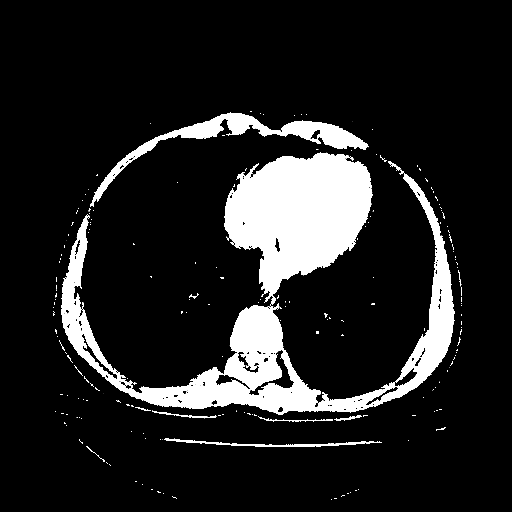 Reconstructed NATIVE CT scan (cycle consistency)