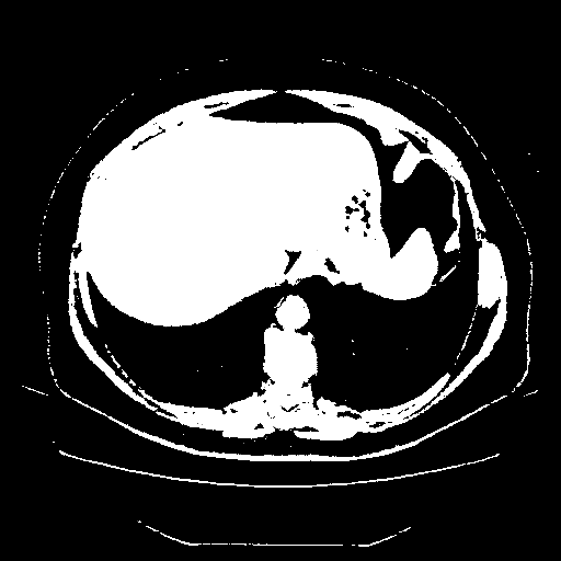Reconstructed NATIVE CT scan (cycle consistency)