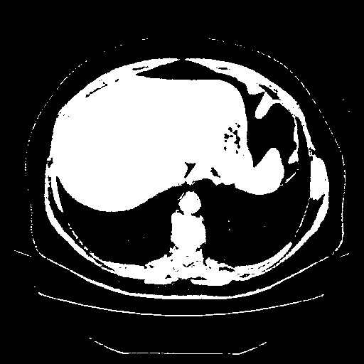 Reconstructed NATIVE CT scan (cycle consistency)
