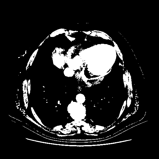 Generated VENOUS CT scan (A→B translation)