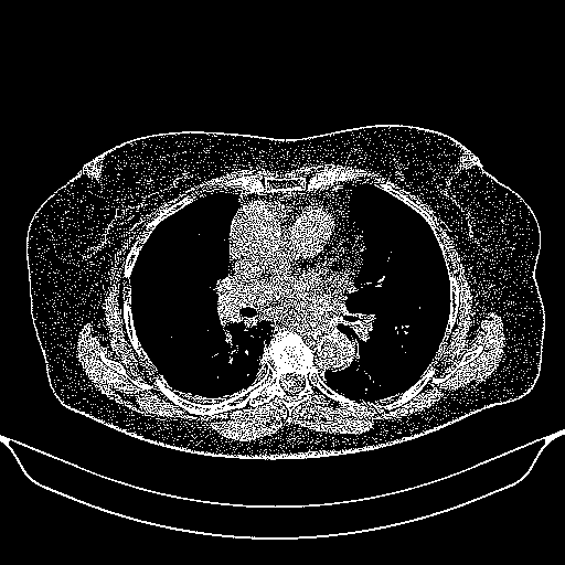 Original NATIVE CT scan (input)