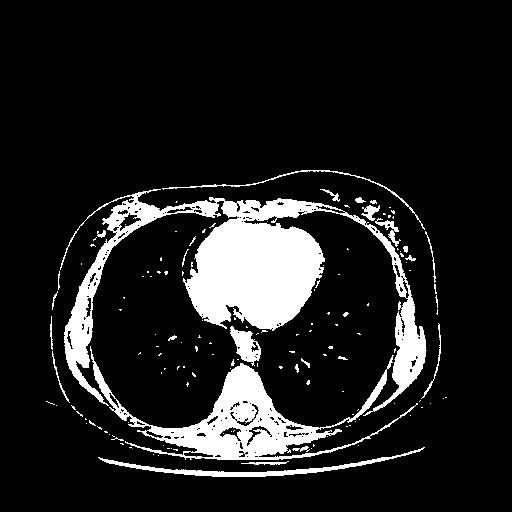 Reconstructed NATIVE CT scan (cycle consistency)