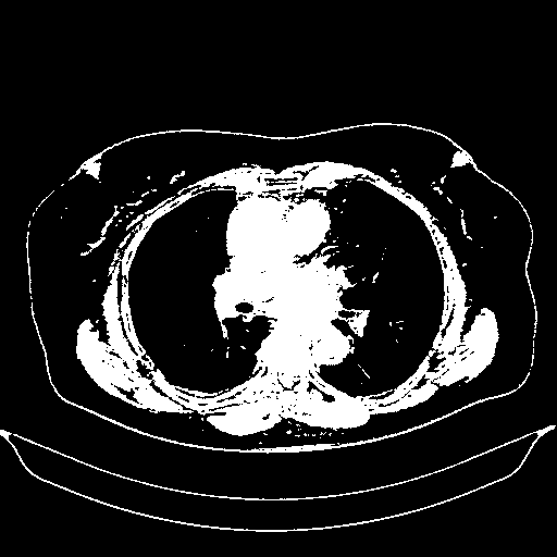 Reconstructed NATIVE CT scan (cycle consistency)