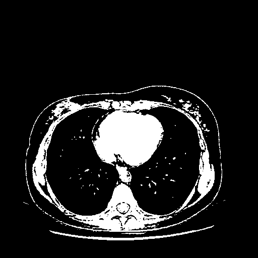 Reconstructed NATIVE CT scan (cycle consistency)