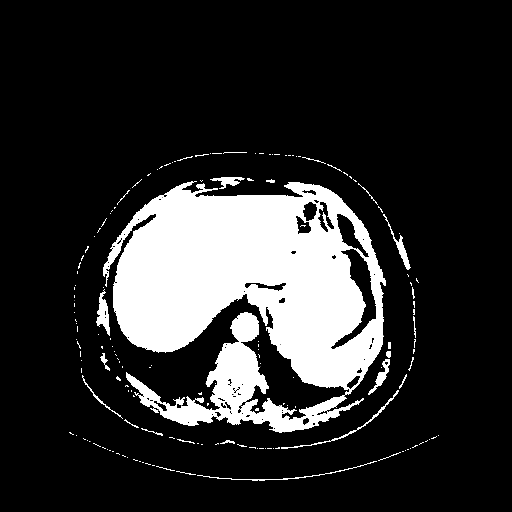 Reconstructed NATIVE CT scan (cycle consistency)